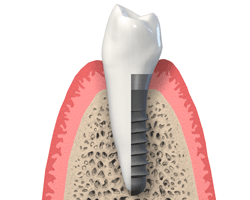 Implantat